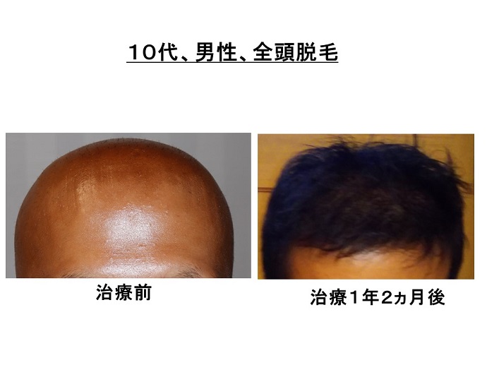 円形脱毛症　病院